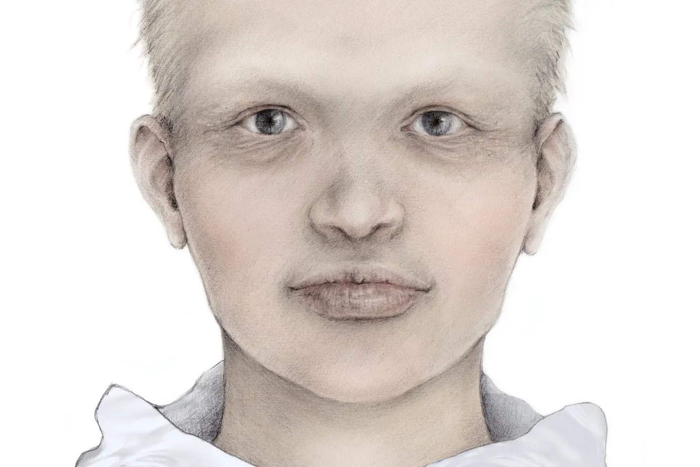 Hypohidrotisk ektodermal dyplasi (HED)